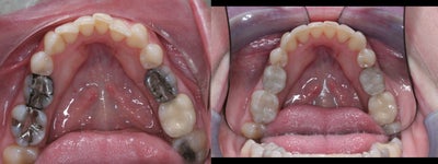 Dental Bonding before and after photo
