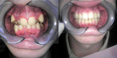Invisalign before and after photo