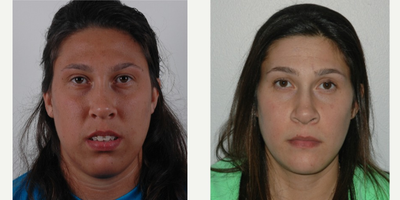 Jaw Surgery before and after photo