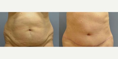 Liposuction before and after photo