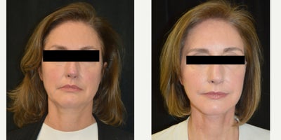 Neck Lift before and after photo