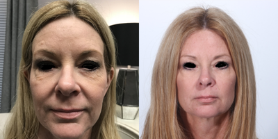 Sculptra before and after photo
