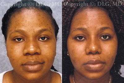 African American Rhinoplasty before and after photo