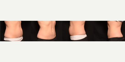 CoolSculpting before and after photo