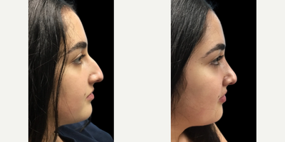 Rhinoplasty before and after photo
