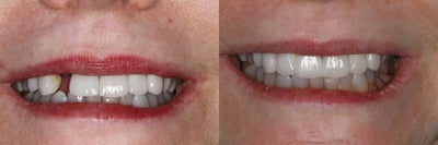 Tooth Repair before and after photo