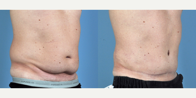 Tummy Tuck before and after photo
