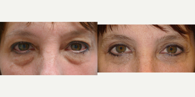 Eyelid Surgery before and after photo