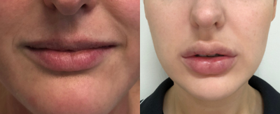 Lip Fillers before and after photo