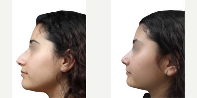 Rhinoplasty before and after photo