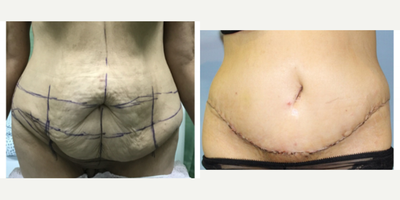 Tummy Tuck before and after photo