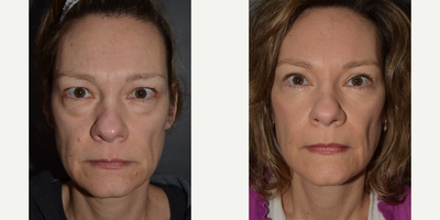 Brow Lift before and after photo