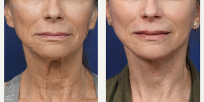 Facelift before and after photo