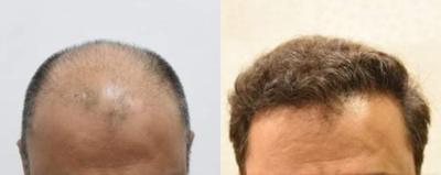FUE Hair Transplant before and after photo