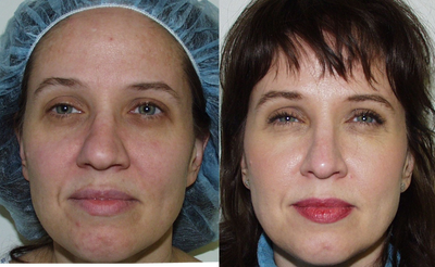 Rhinoplasty before and after photo