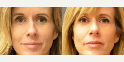 Rhinoplasty before and after photo