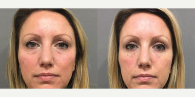 Vollure before and after photo
