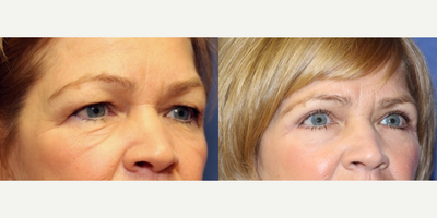 Eyelid Surgery before and after photo
