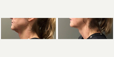 Kybella before and after photo