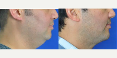 Chin Implant before and after photo