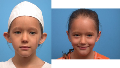 Ear Surgery before and after photo