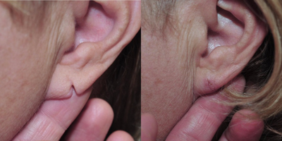 Earlobe Repair before and after photo