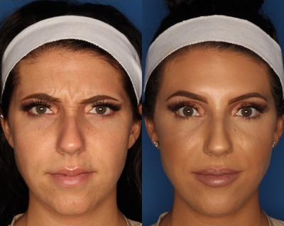 Botox before and after photo
