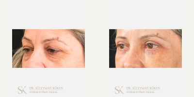 Eyelid Surgery before and after photo