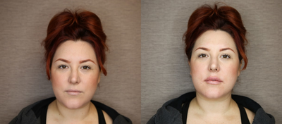 Juvederm before and after photo