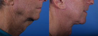 Deep Plane Facelift before and after photo