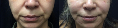 Dermal Fillers before and after photo