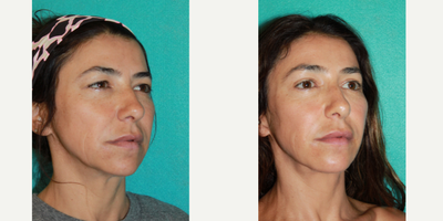 Eyelid Surgery before and after photo