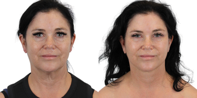 Eyelid Surgery before and after photo