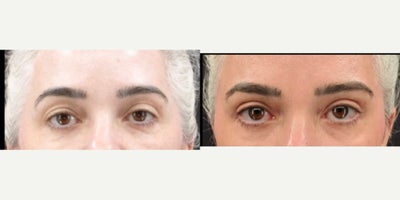 Eyelid Surgery before and after photo