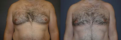 Gynecomastia Surgery before and after photo