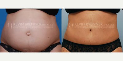 Tummy Tuck before and after photo
