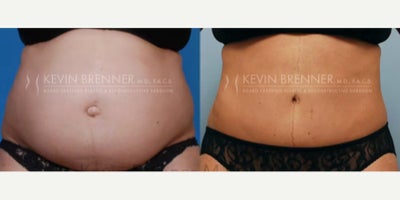 Tummy Tuck before and after photo