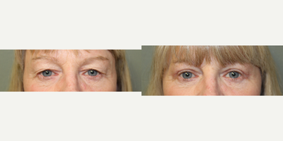 Eyelid Surgery before and after photo