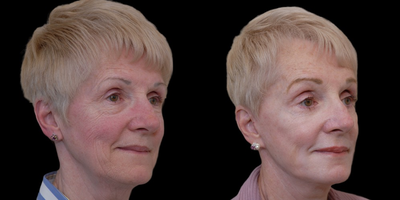 Eyelid Surgery before and after photo