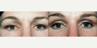 Eyelid Surgery before and after photo