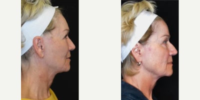 Facelift before and after photo