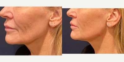 Radiesse before and after photo