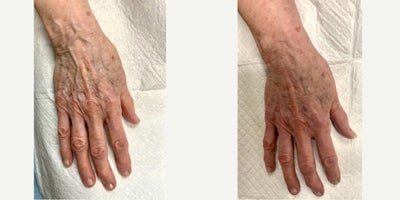 Sclerotherapy before and after photo