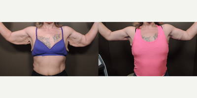 Arm Lift before and after photo