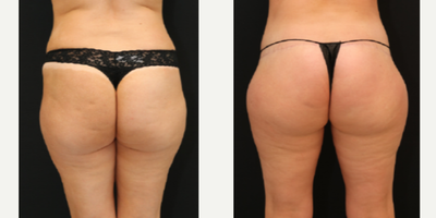 Brazilian Butt Lift before and after photo