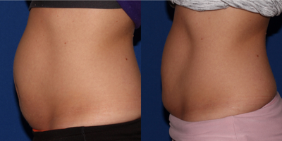CoolSculpting before and after photo