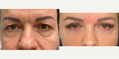 Eyelid Surgery before and after photo