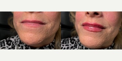 Lip Fillers before and after photo