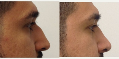 Rhinoplasty before and after photo