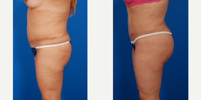 Brazilian Butt Lift before and after photo